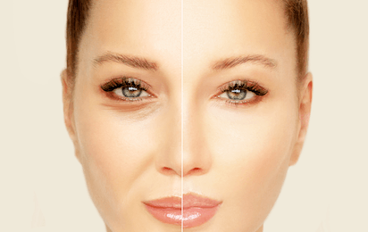 Dermal Fillers small