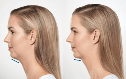 Sculptra Before and After 2